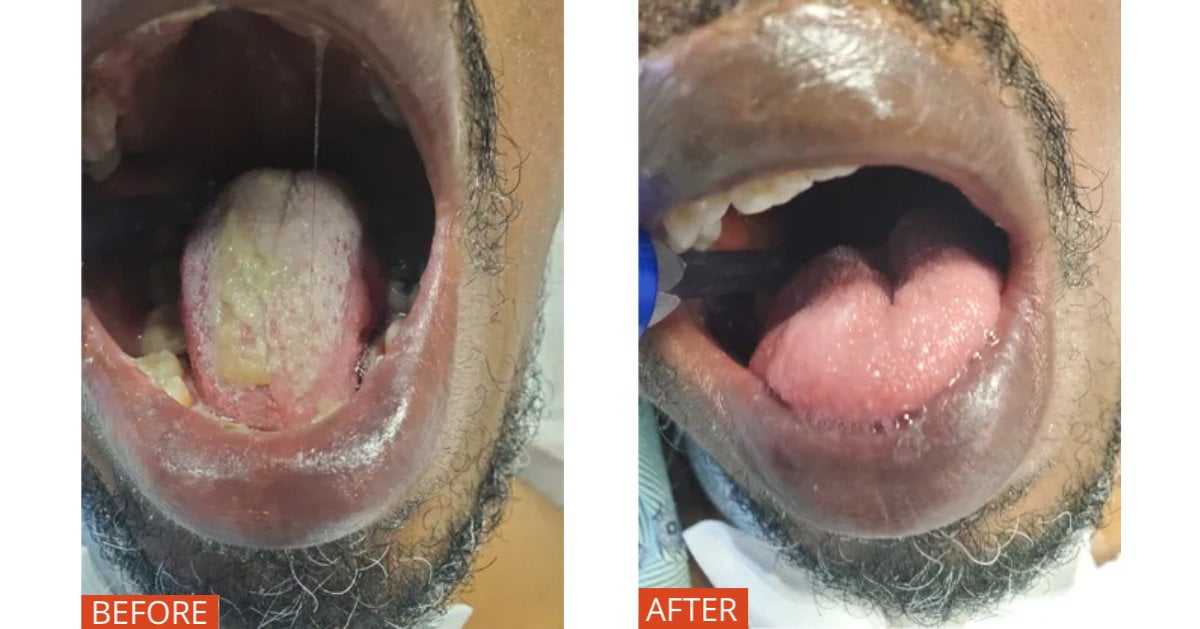 Before and After Scrape-n-Suction Tongue Cleaner